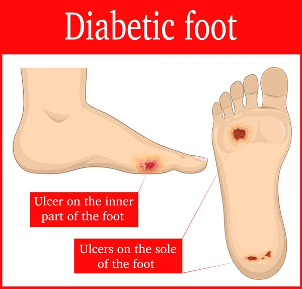 Diyabetik ayak çizimi — Stok Vektör