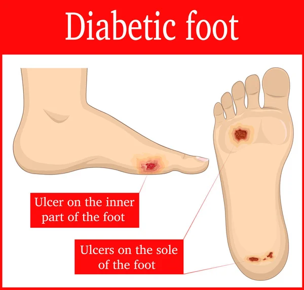 Ilustración del pie diabético — Archivo Imágenes Vectoriales