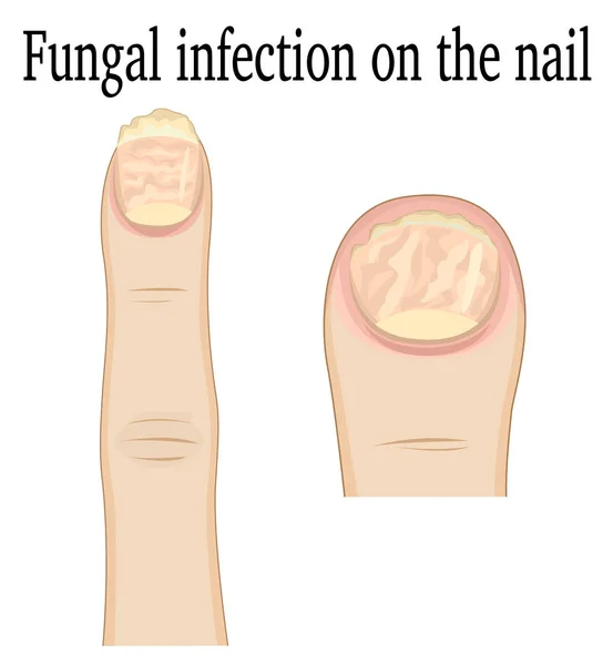 Infección por hongos en las uñas — Vector de stock