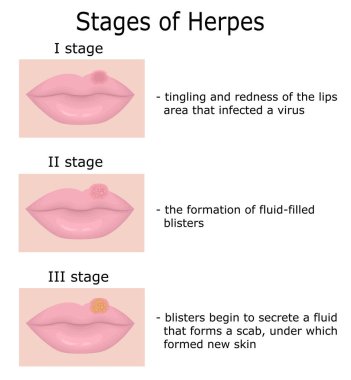 Herpes aşamaları