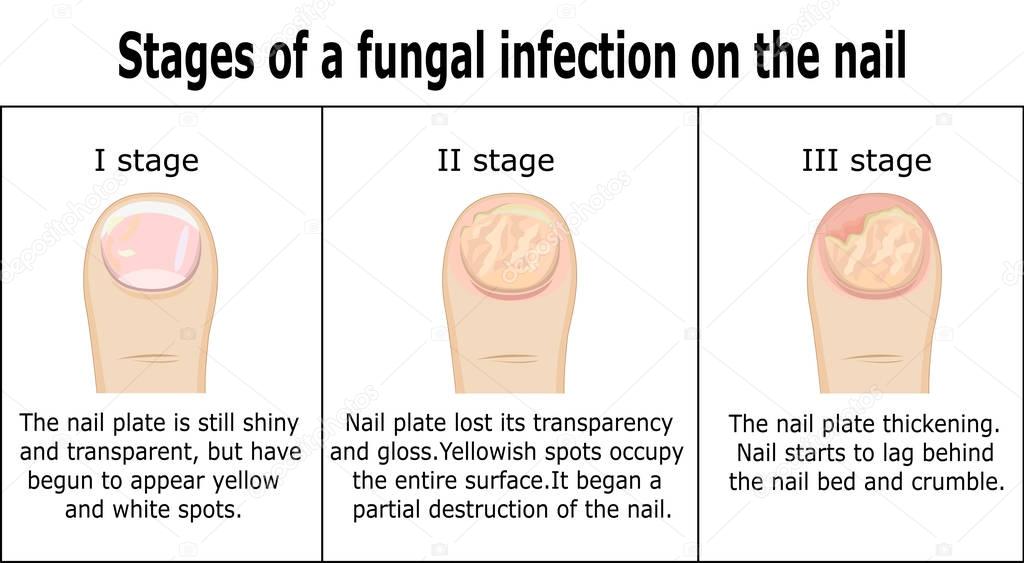 Stages of a fungal infection on the nail