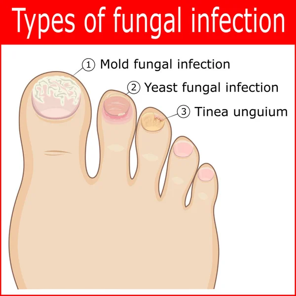 Types of fungal infections — Stock Vector