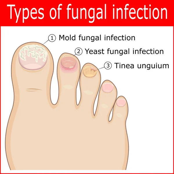 Tipos de infecções fúngicas —  Vetores de Stock