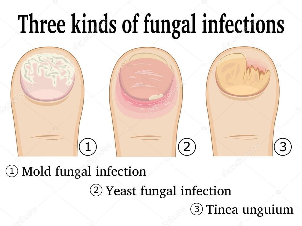 Three kinds of fungal infections