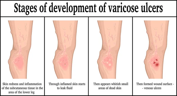 Stages of development of varicose ulcers — Stock Vector