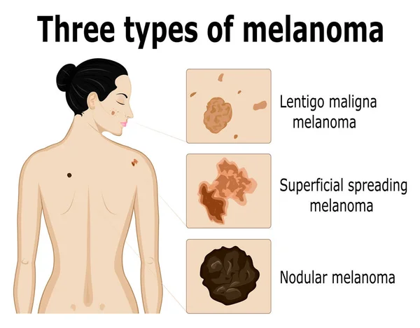 Tři typy melanomu — Stockový vektor