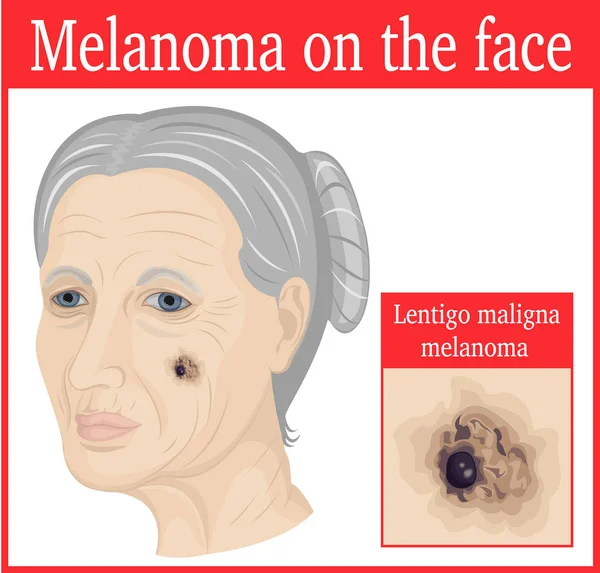 Melanoma en la mejilla — Vector de stock