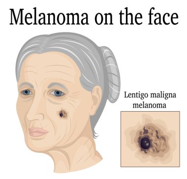 Melanom yüz