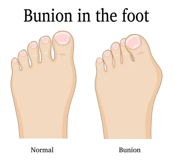 Bunyon ayak