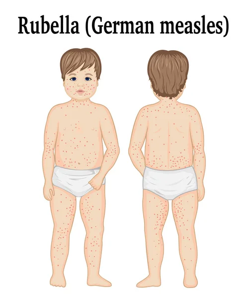 A child with rubella — Stock Vector