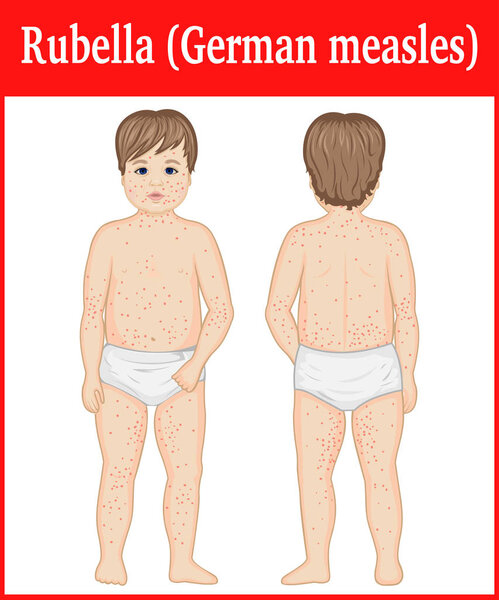A child infected with rubella
