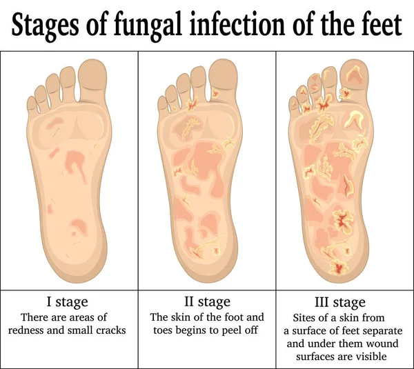 Infección fúngica en los pies — Vector de stock