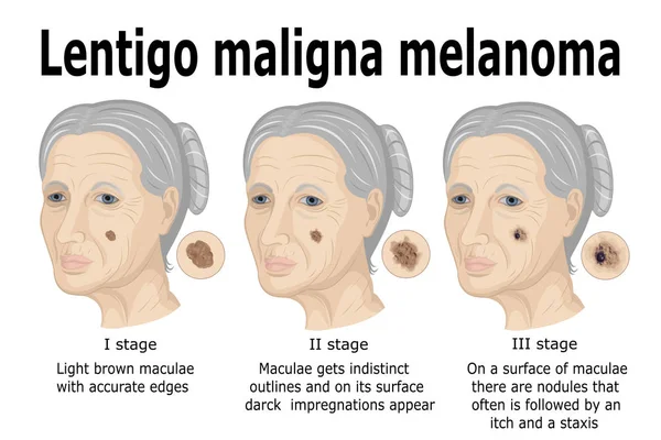 Lentigo maligna mélanome — Image vectorielle