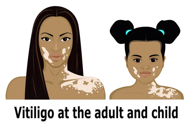 성인과 어린이에서 vitiligo — 스톡 벡터