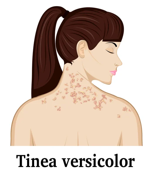 Ilustração de Tinea versicolor —  Vetores de Stock