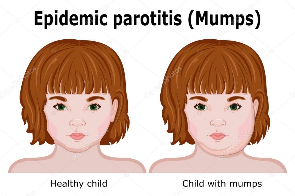 A child with symptoms of mumps