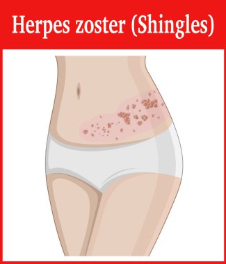 Herpes zoster çizimi