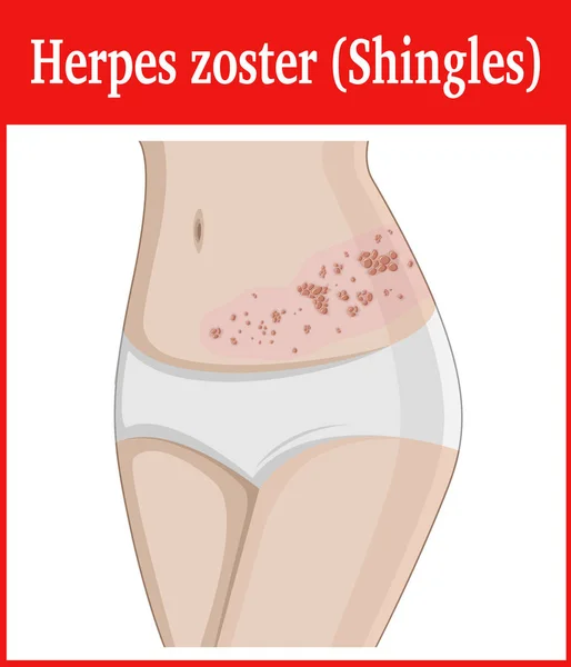 Illustration of Herpes zoster — Stock Vector