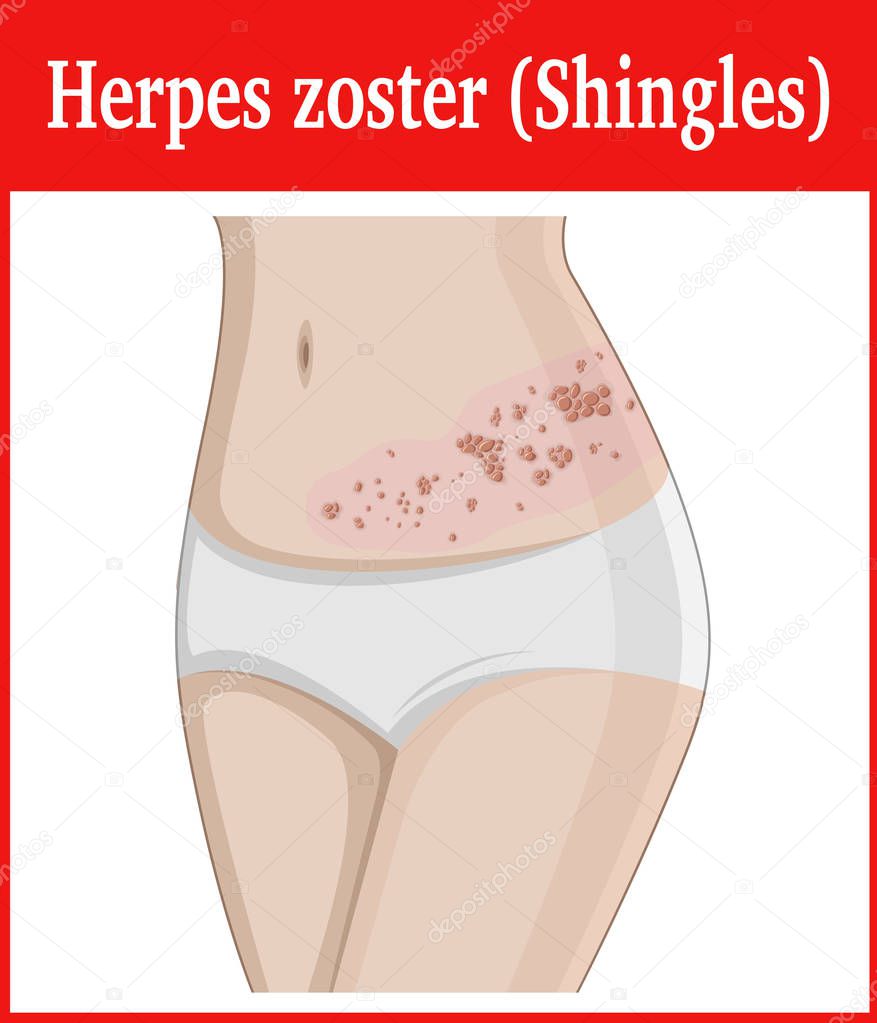 Illustration of Herpes zoster