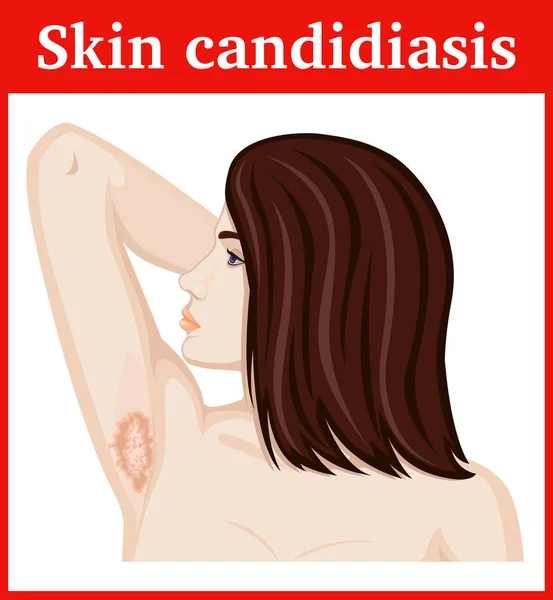 Ilustración de candidiasis cutánea — Vector de stock