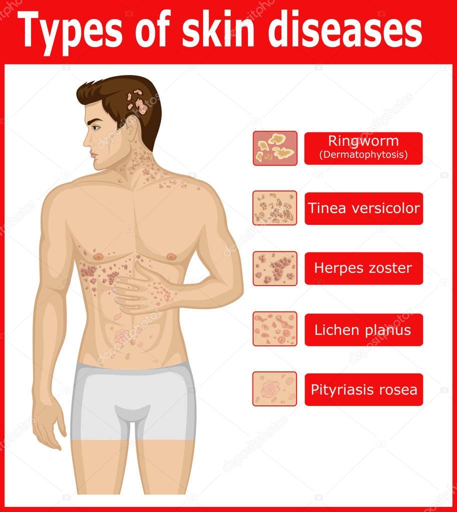 Types of skin diseases