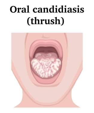 Oral kandidiyaz çizimi