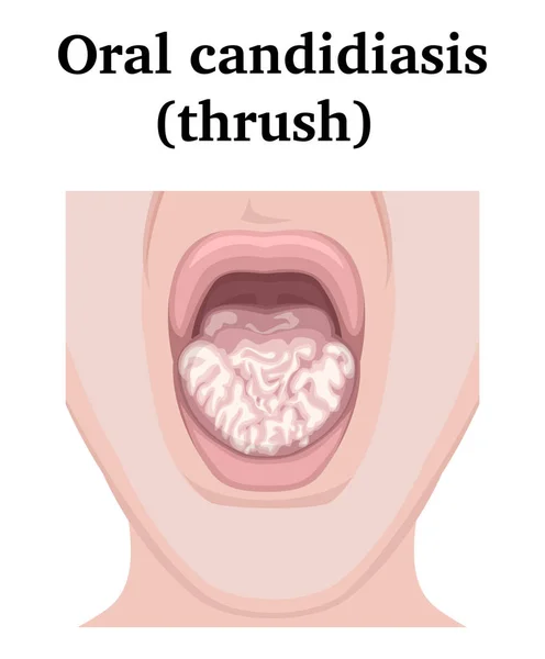 Ilustración de la candidiasis oral — Archivo Imágenes Vectoriales