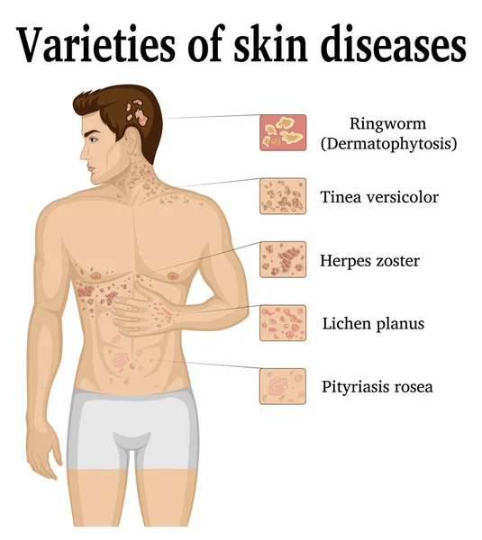 Variedades de enfermedades de la piel — Vector de stock