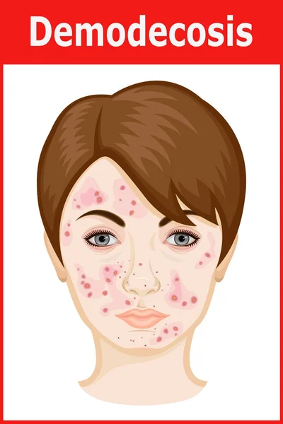 Illustration of Demodicosis on the face — Stock Vector