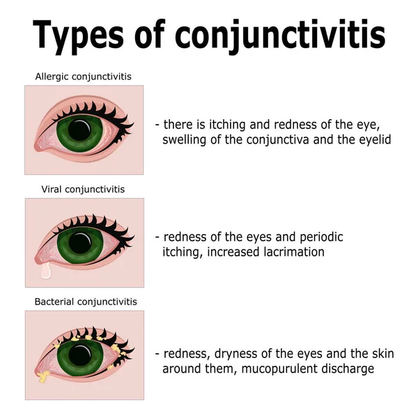 Types of conjunctivitis — Stock Vector