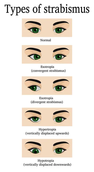 Types of strabismus — Stock Vector
