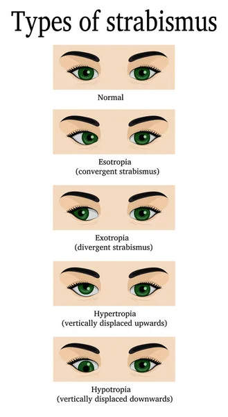 Typy strabismus — Stockový vektor