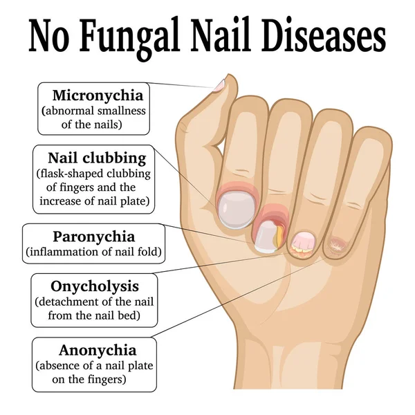 没有指甲的真菌疾病 — 图库矢量图片
