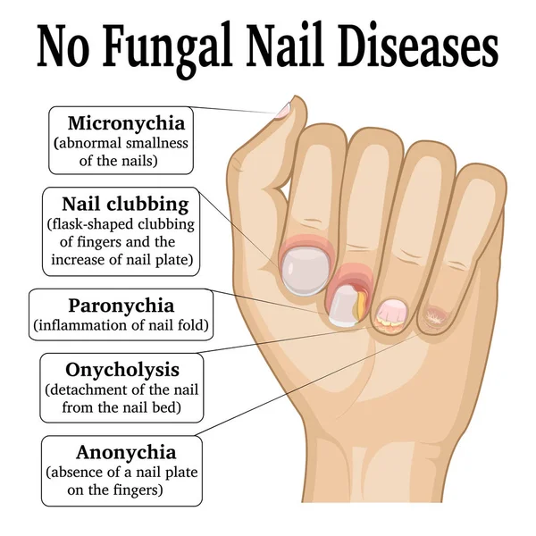 Žádná nemoc mykotických nehtů — Stockový vektor