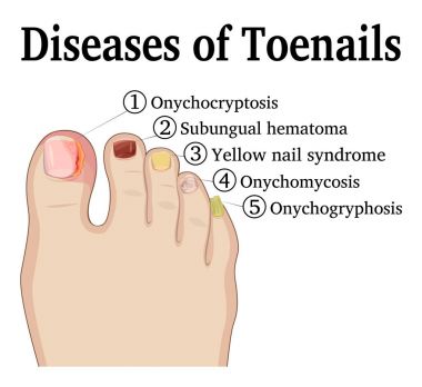 Diseases of Toenails clipart