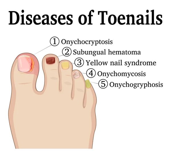 Enfermedades de las uñas de los pies — Vector de stock