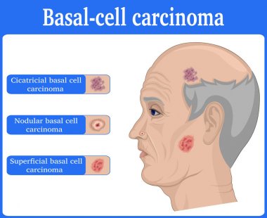 Illustration of Basal cell carcinoma clipart