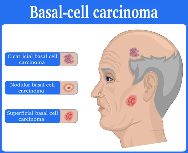Illustration of Basal cell carcinoma — Stock Vector