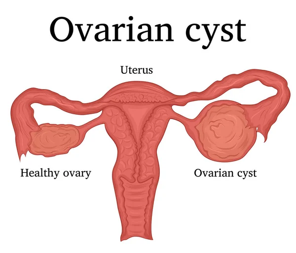 Illustrazione della cisti ovarica — Vettoriale Stock