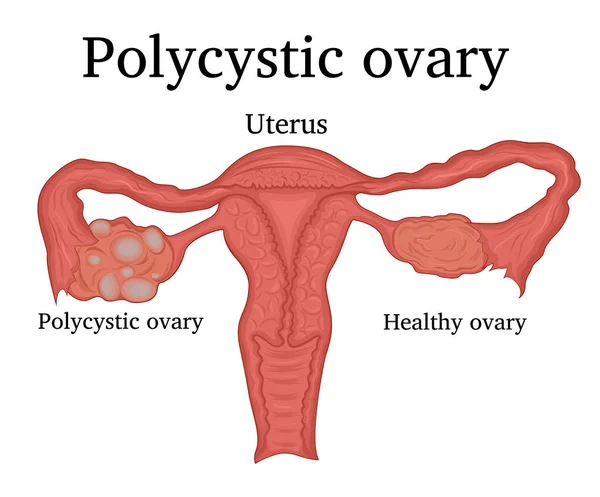 Ilustrace polycystických ovarií — Stockový vektor