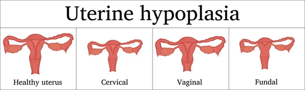Illustrazione dell'ipoplasia uterina — Vettoriale Stock