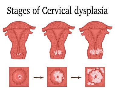 Illustration of Cervical dysplasia clipart