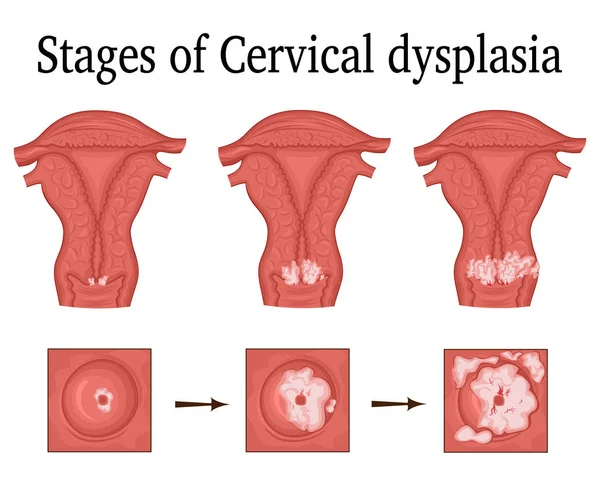 Illustration der zervikalen Dysplasie — Stockvektor