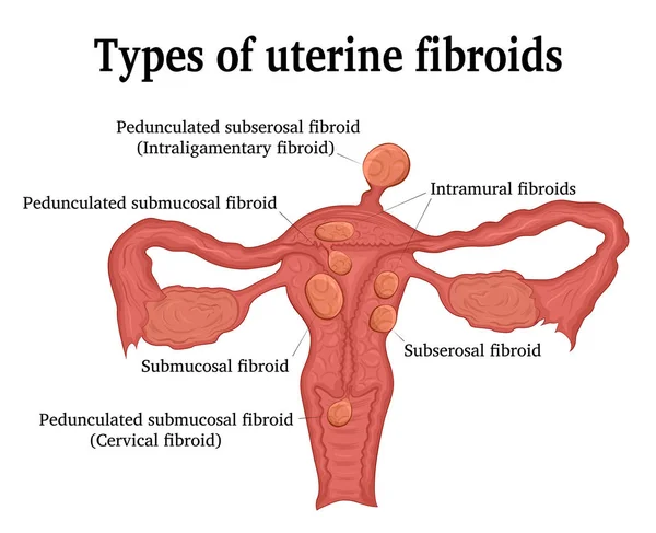 Tipos de fibromas uterinos — Vector de stock