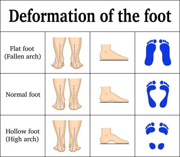 Deformation of the foot — Stock Vector