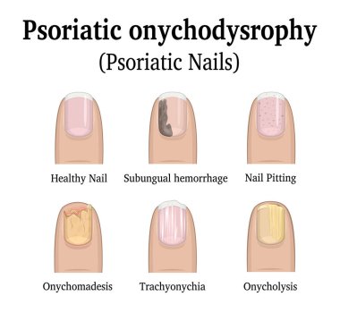 Types of nail psoriasis clipart