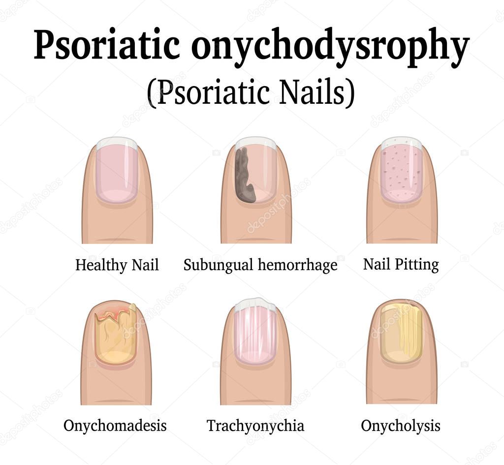 Types of nail psoriasis