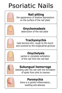 Ilustration of psoriatic nails clipart