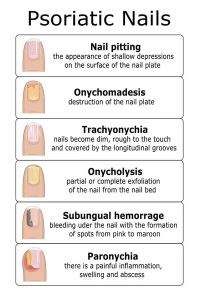 Ilustração das unhas psoriáticas — Vetor de Stock