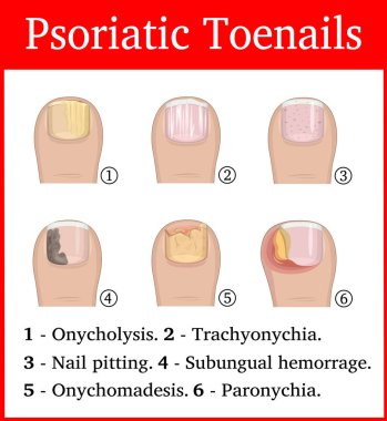 Psoriatik ayak tırnaklarını çizimi